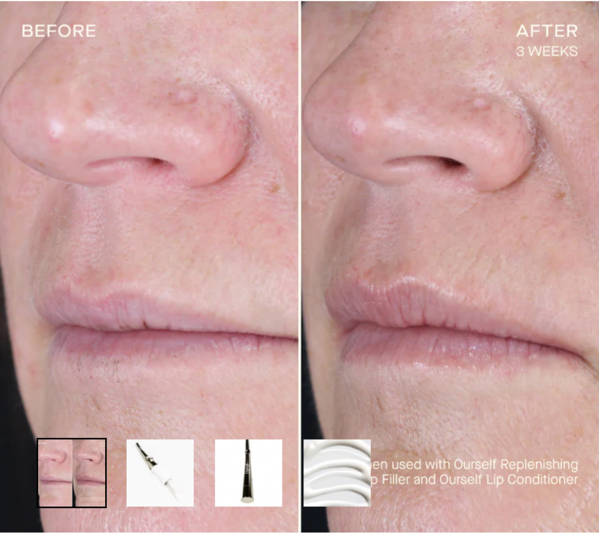 Ourself replenishing lip filler